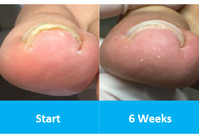 Onyfix Treatment Example 2 - Before and After