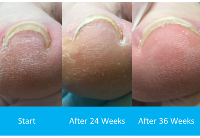 Onyfix Treatment Example 3 - Before and After