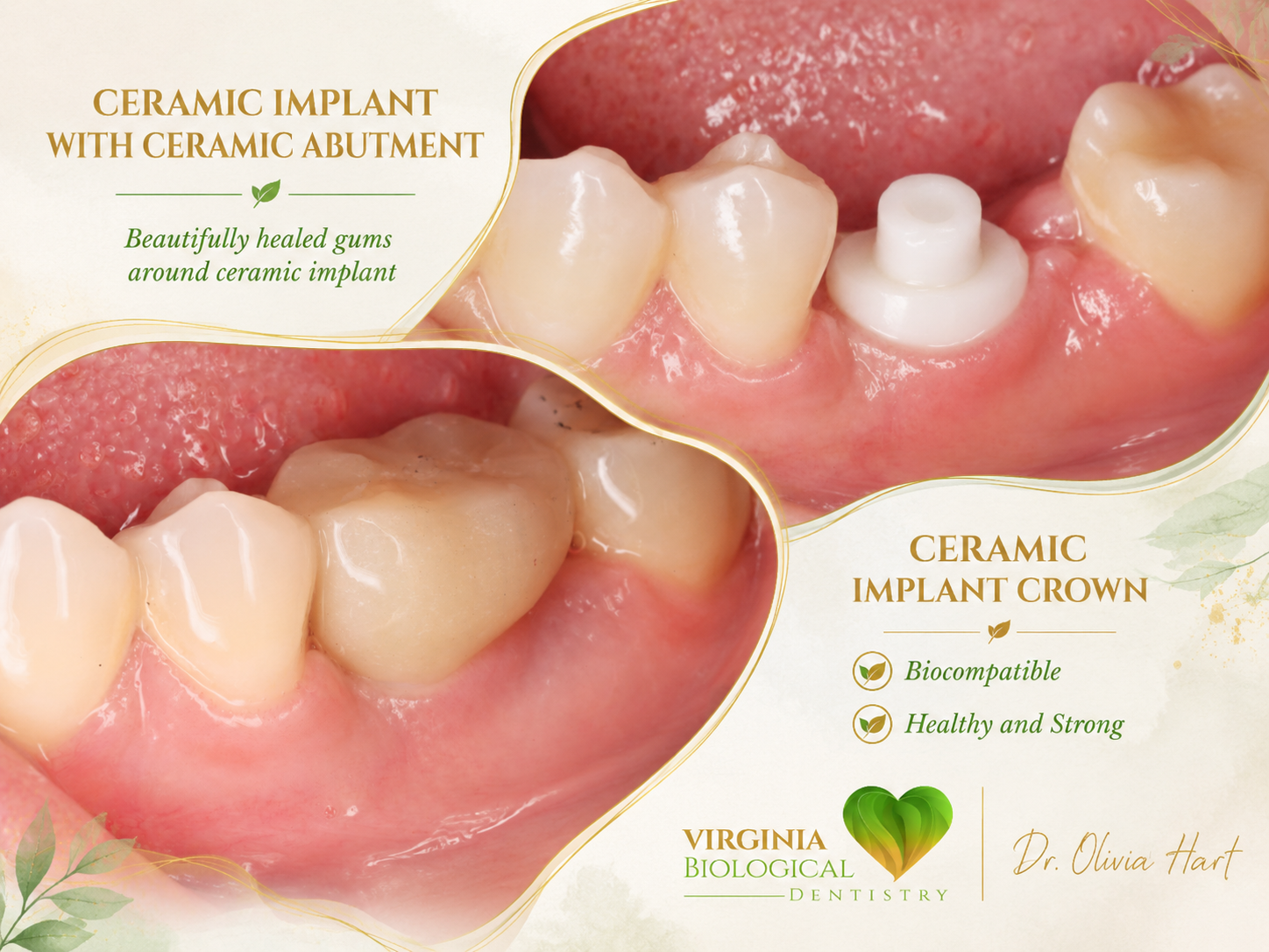 Dental Implants Before and After | Same-Day Ceramic Implant Cases