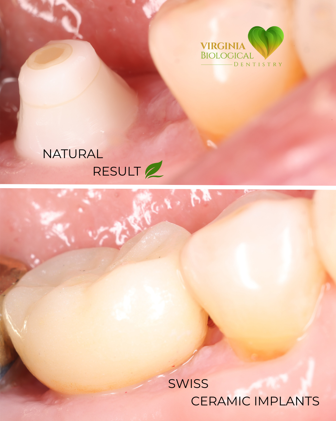 X-Guide Navigated Ceramic Dental Implants by Your Biological